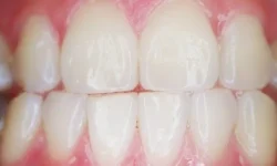 How Does Teeth Whitening Work?